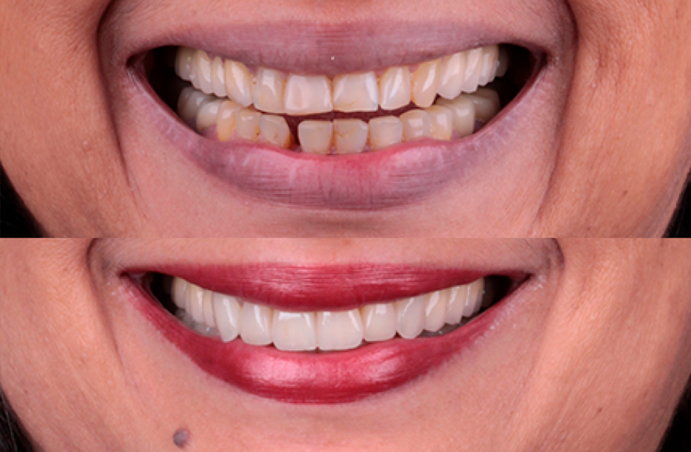 Imagem seção lentes de contato dentais em porcelana Octavio Benatti