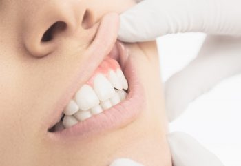 hpv e saúde bucal clínica benatti odontologia