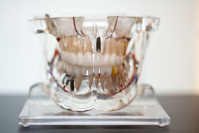 prótese fixa clínica benatti odontologia