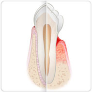 tratamento de periodontite clínica benatti odontologia