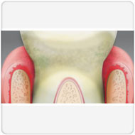 tratamento de periodontite clínica benatti odontologia