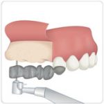 implantes dentários benatti odontologia
