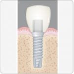 implante colocado em seção cruzada benatti odontologia