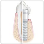 implantes osseointegrado benatti odontologia