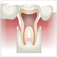 raspagem dos dentes Benatti Odontologia