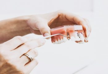 Como É Feito Um Implante Dentário?