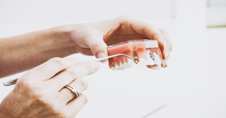 Como É Feito Um Implante Dentário?