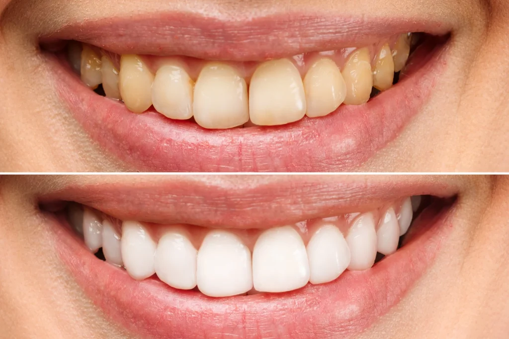 clareamento dentário