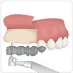 cirurgia de implante dentário