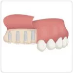 cirurgia de implante dentário