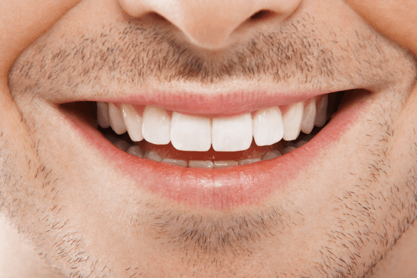 clareamento dental a laser