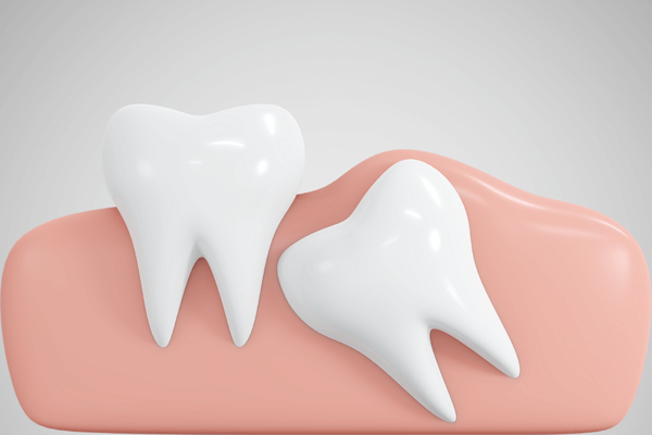 perguntas frequentes sobre dente do siso