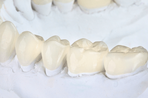 prótese dentária fixa