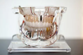 prótese fixa dentária