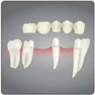 prótese fixa dentária