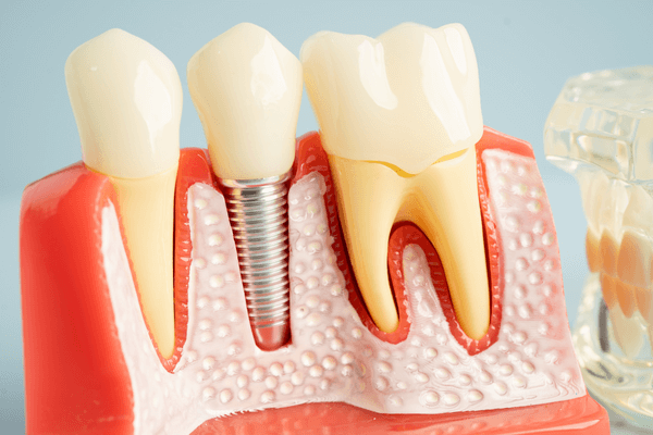 prótese sob implantes