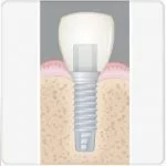 tipos de prótese dentária