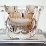 tipos de prótese dentária