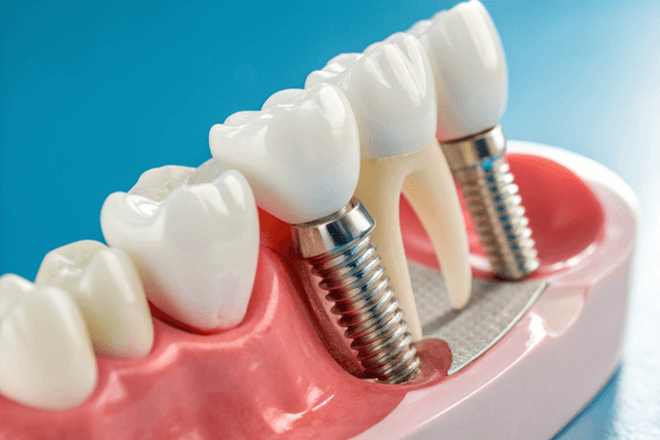 tipos prótese dentária
