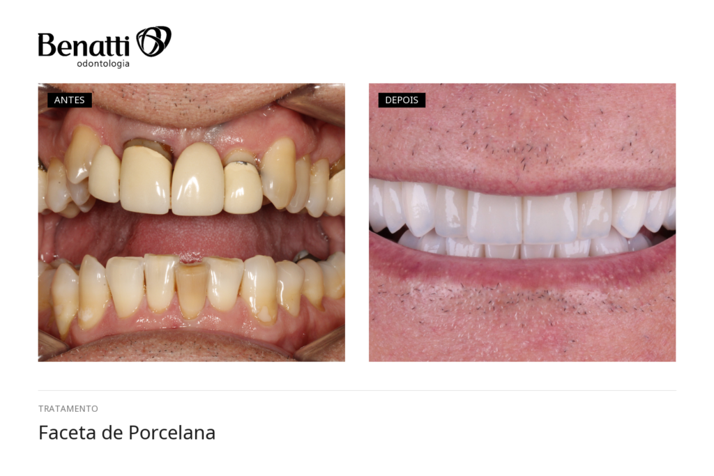 Antes e depois faceta de porcelana