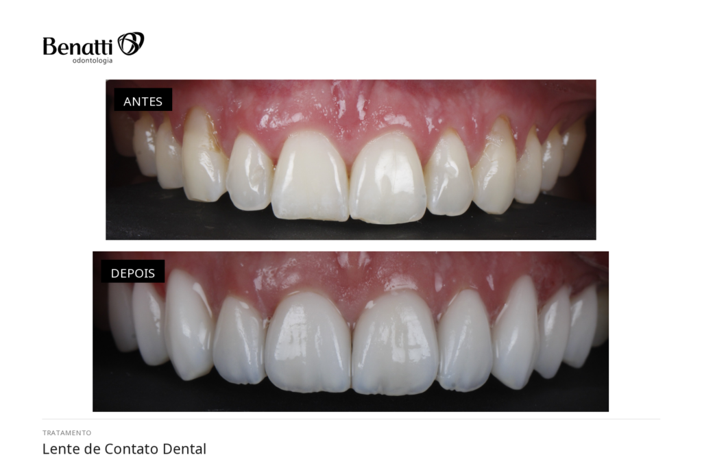Antes e Depois Lentes de Contato