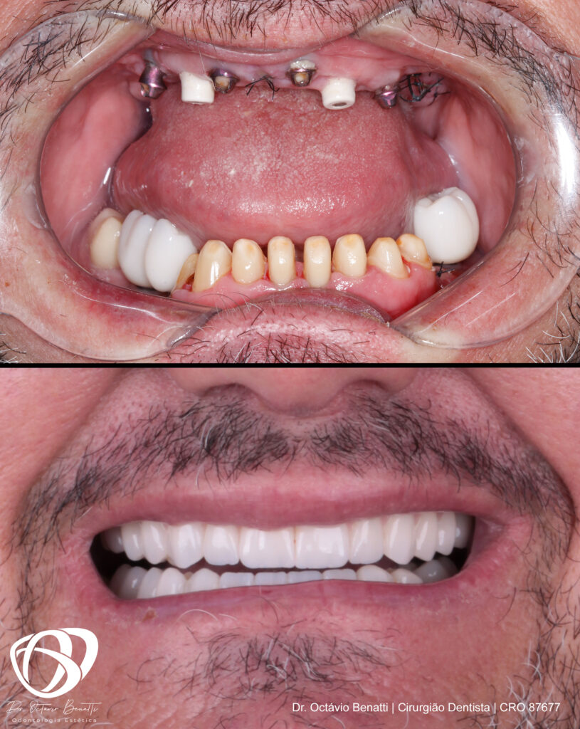 Quanto Tempo Dura Um Implante Dentário - Antes e Depois