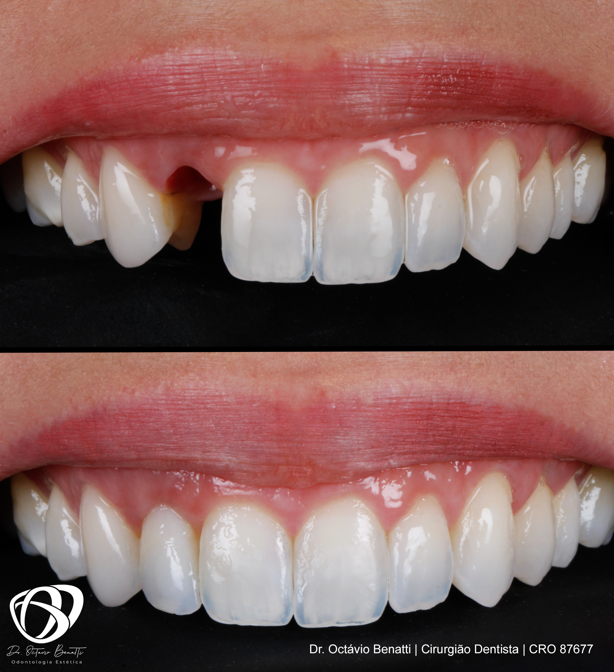 Quanto Tempo Dura Um Implante Dentário? Entenda o Assunto