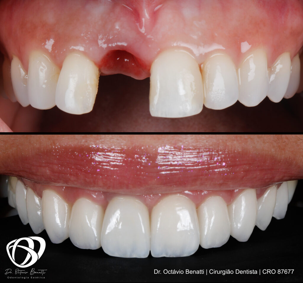 Quanto Tempo Dura Um Implante Dentário - Antes e Depois