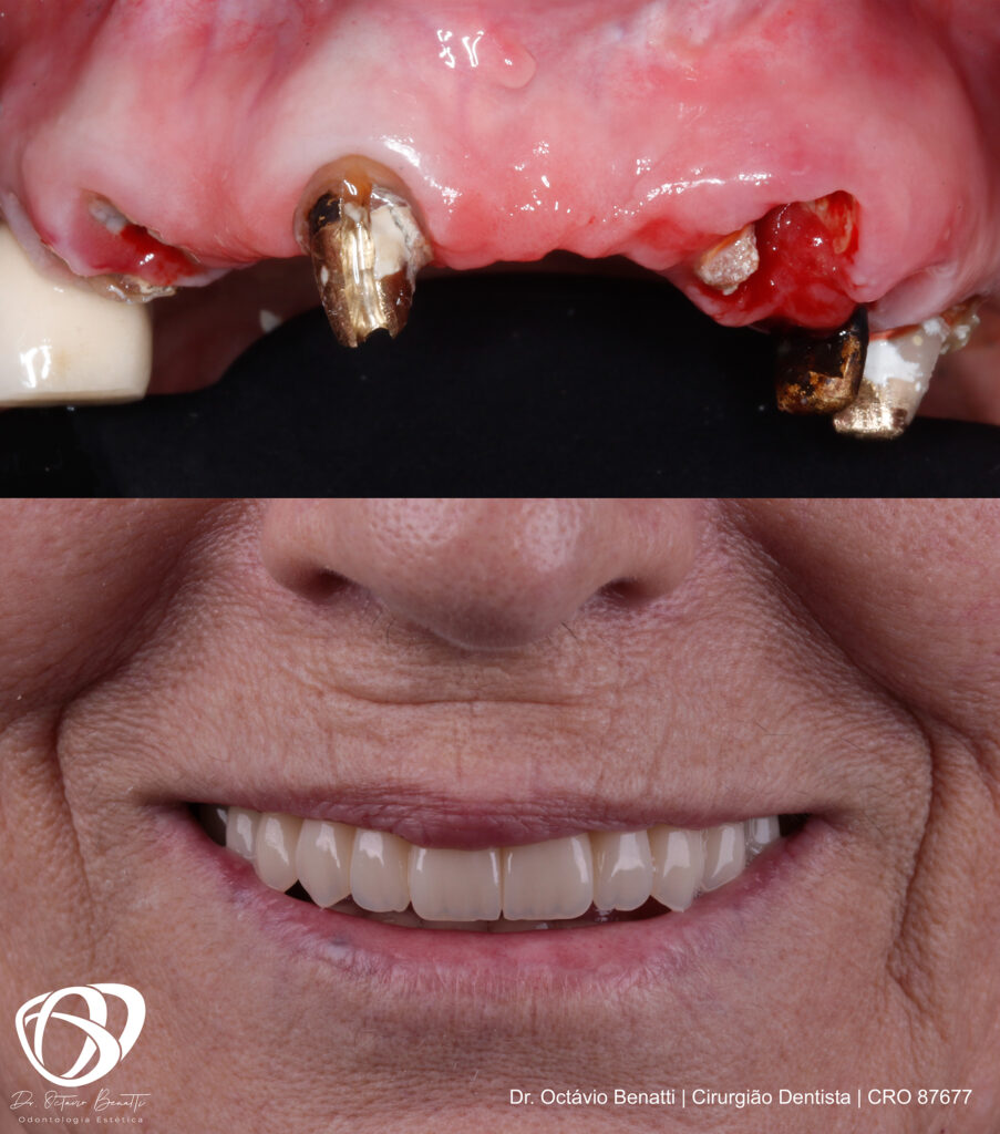 Quanto Tempo Dura Um Implante Dentário - Antes E Depois